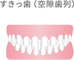 すきっ歯（空隙歯列）